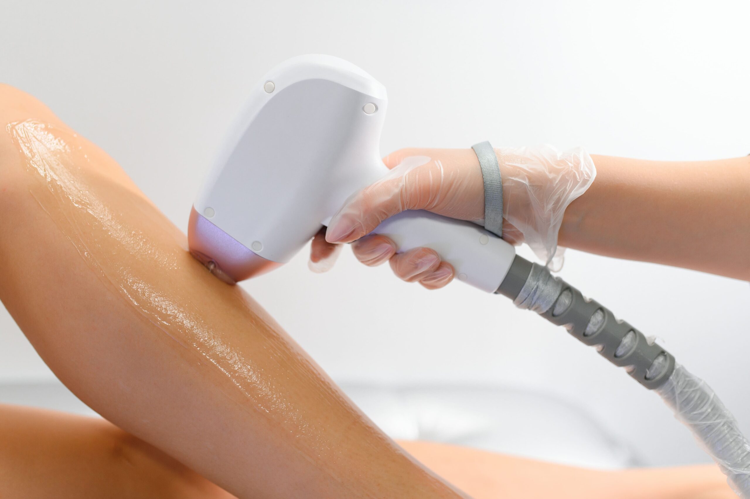 epilazione laser quante sedute